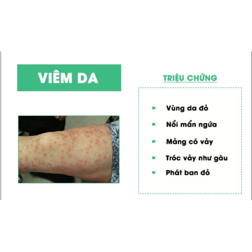 Bệnh da liễu là những bệnh có biểu hiện ngoài da do nhiều tác nhân gây nên, thông thường là do dị ứng, vi khuẩn, virus hoặc do cơ địa của người bệnh. Bệnh da liễu không gây nguy hiểm đến tính mạng nhưng lại ảnh hưởng nghiêm trọng đến sức khỏe cũng như tâm lý của người bệnh. Đặc biệt người mắc bệnh da liễu thường cảm thấy tự ti, mặc cảm do mất thẩm mỹ ở bờ mặt da. Bệnh da liễu là những bệnh có biểu hiện ngoài da do nhiều tác nhân gây nên, thông thường là do dị ứng, vi khuẩn, virus hoặc do cơ địa của người bệnh. Bệnh da liễu không gây nguy hiểm đến tính mạng nhưng lại ảnh hưởng nghiêm trọng đến sức khỏe cũng như tâm lý của người bệnh. Đặc biệt người mắc bệnh da liễu thường cảm thấy tự ti, mặc cảm do mất thẩm mỹ ở bờ mặt da.