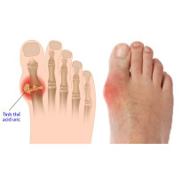 Bạn đã hiểu rõ về căn bệnh gút