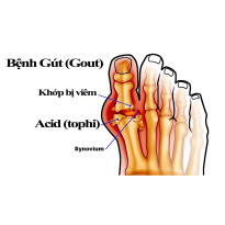 Bệnh Gút (gout)