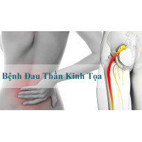 Đau thần kinh tọa