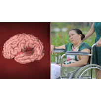 Đột quỵ thiếu máu não cục bộ