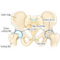 Phục hồi chức năng cho bệnh nhân sau phẫu thuật thay khớp háng nhân tạo