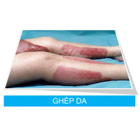 Ghép da là gì?