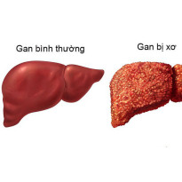 Bệnh xơ gan - nguyên nhân và điều trị