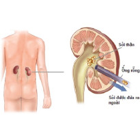 Những triệu chứng và cách phòng ngừa sỏi thận