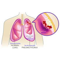 Tràn khí màng phổi