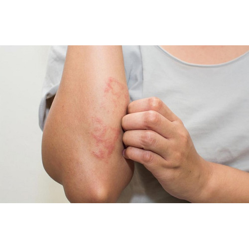 Bệnh viêm da dị ứng có thể xảy ra ở bất cứ vị trí nào trên cơ thể và có xu hướng bùng phát khi thời tiết thay đổi, khô hanh. Triệu chứng và cách phòng ngừa viêm da dị ứng như thế nào?