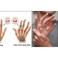 11 lý do khiến bệnh viêm khớp dạng thấp "tấn công" nhiều người: Nên điều chỉnh lại ngay